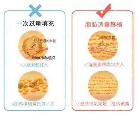 脂肪填充術后要注意忌口，忌辛辣刺激性食物