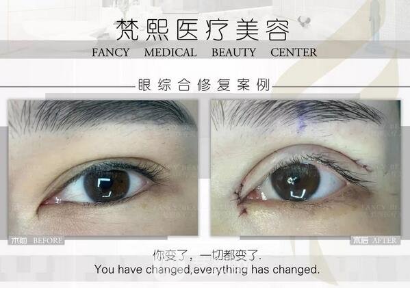 雙眼皮修復