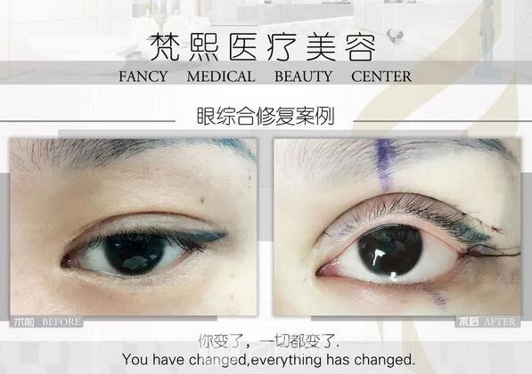 雙眼皮修復案例圖