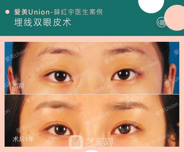 埋線雙眼皮手術(shù)案例圖