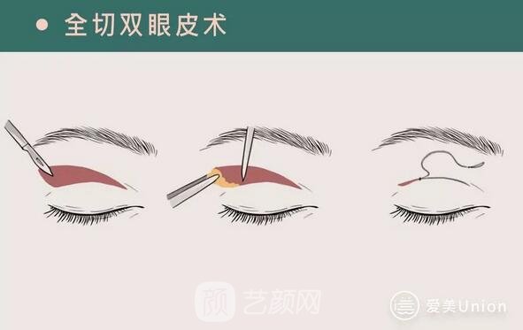 全切雙眼皮手術(shù)
