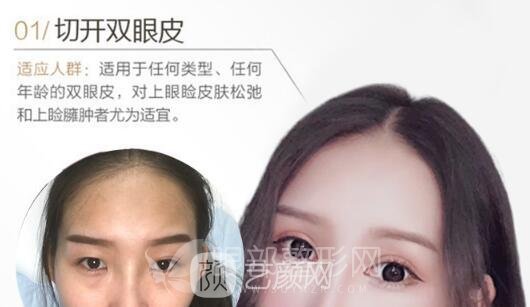 雙眼皮手術怎么做