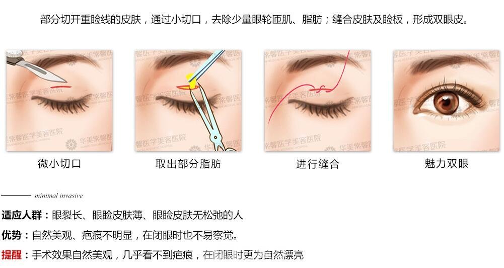 常說的微創(chuàng)雙眼皮是不是就是韓式定點雙眼皮呢？