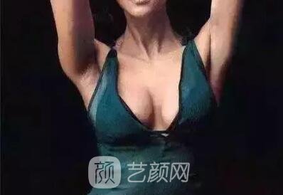假體豐胸手術(shù)術(shù)后怎樣護(hù)理?
