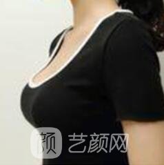 假體隆胸失敗修復(fù)手術(shù)后怎樣護(hù)理?