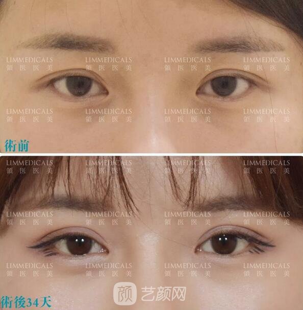 雙眼皮案例圖