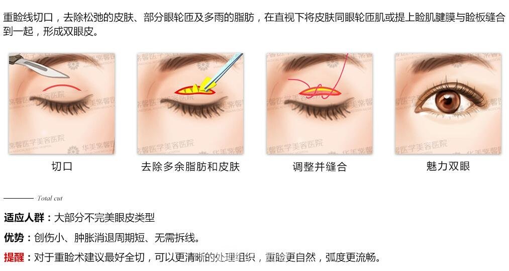 割雙眼皮哪種方法好？全切怎么樣