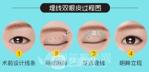 雙眼皮埋線法好不好 你的眼型該如何選擇術式