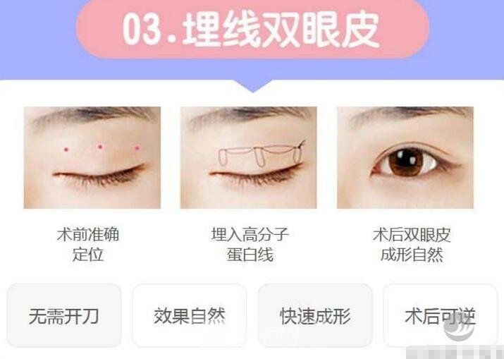 拉線雙眼皮是埋線嗎？