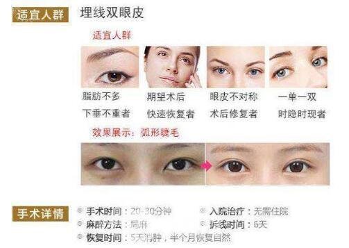 拉線雙眼皮是埋線嗎？適合哪些人？