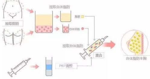 自體脂肪隆胸術(shù)有哪些禁忌？