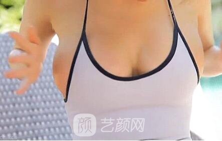 如何選擇假體形狀?