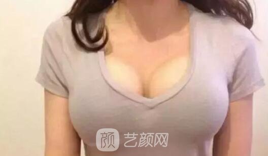 隆胸修復(fù)手術(shù)的常見問題