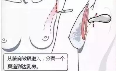 假體豐胸