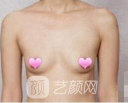 水凝膠假體