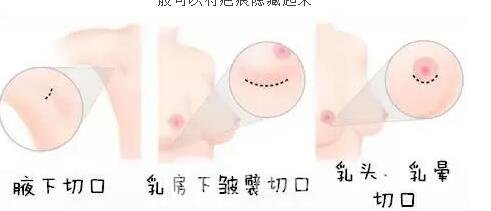 胸部敏感度會受隆胸手術(shù)的影響嗎？