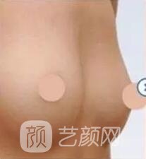 胸部敏感度會受隆胸手術(shù)的影響嗎？