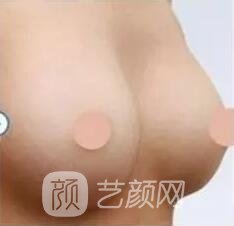 胸部敏感度會受隆胸手術(shù)的影響嗎？