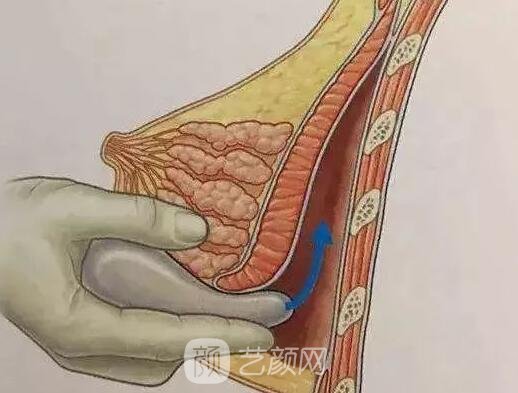 胸部敏感度會受隆胸手術(shù)的影響嗎？
