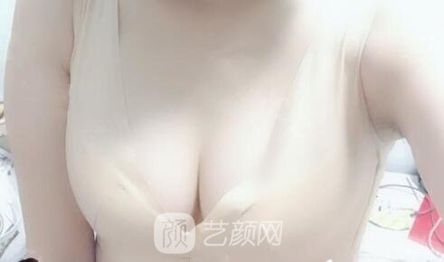 真實影響造成胸部下垂的要素是什么？