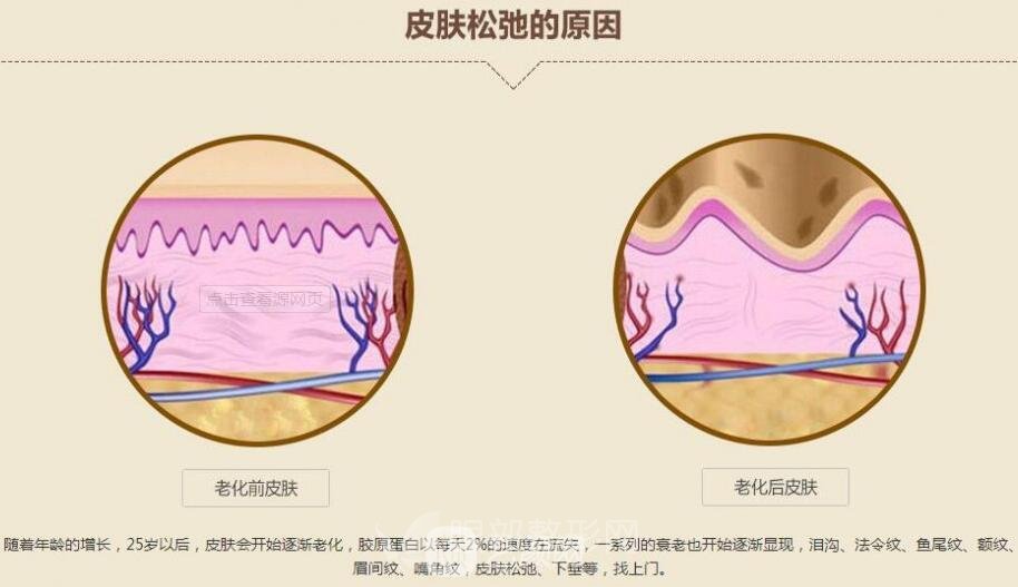 眼部微整形 祛除魚尾紋 果好不好