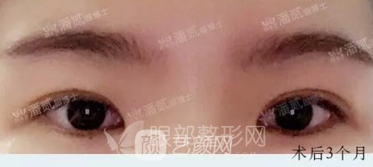 韓式小切口雙眼皮案例圖，術(shù)后3個(gè)月果圖