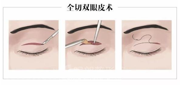 割雙眼皮較全攻略，術(shù)前你一定要get的知識(shí)！
