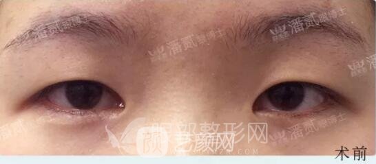 韓式小切口雙眼皮案例圖，術(shù)前