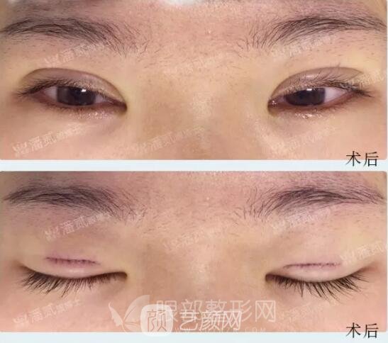 韓式小切口雙眼皮案例圖，術(shù)后果