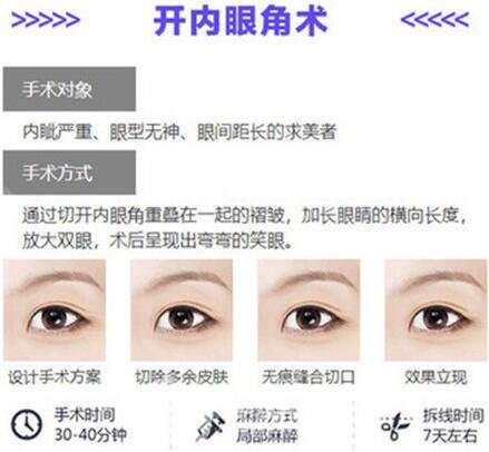 開(kāi)眼角手術(shù)