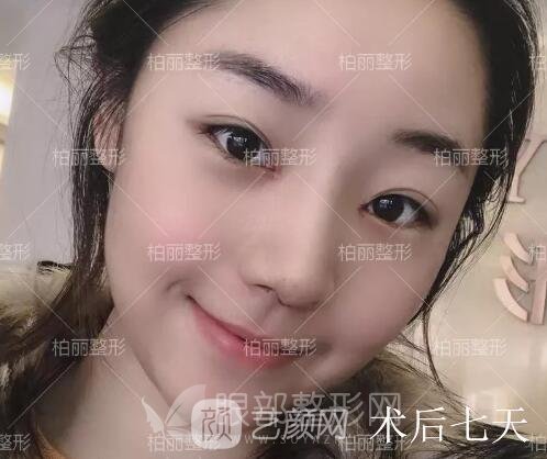 開(kāi)眼角多久恢復(fù) 半個(gè)月夠嗎