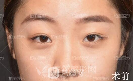 開(kāi)眼角多久恢復(fù) 真人案例分享