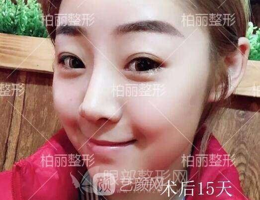 開(kāi)眼角多久恢復(fù) 術(shù)后15天果分享