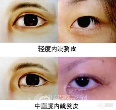 內(nèi)眥贅皮