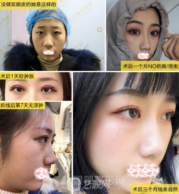 醫(yī)生告訴我開眼角需要多長時間恢復(fù)，我來解答！
