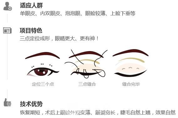 韓式三點(diǎn)定位雙眼皮手術(shù)原理簡(jiǎn)介