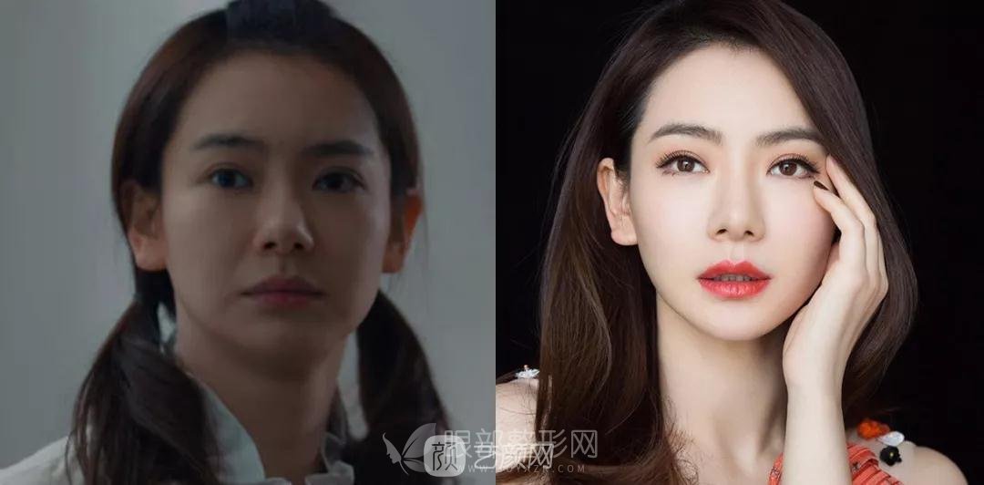 做雙眼皮手術(shù)怎么選
