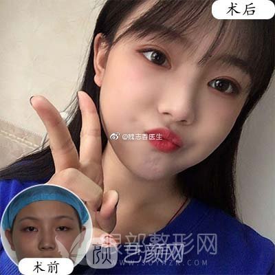 韓式三點(diǎn)定位雙眼皮果（圖）