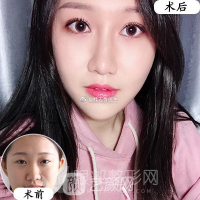 韓式三點(diǎn)定位雙眼皮一般多少錢(qián)