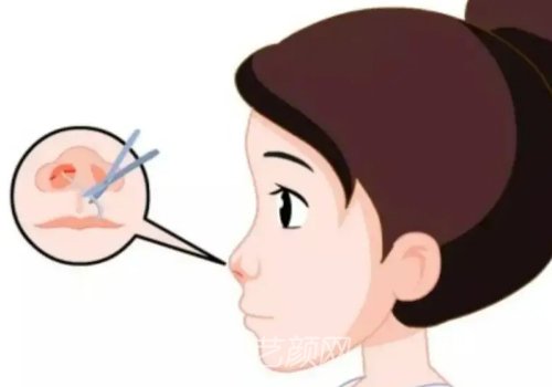 李勁良做鼻子價(jià)格是多少